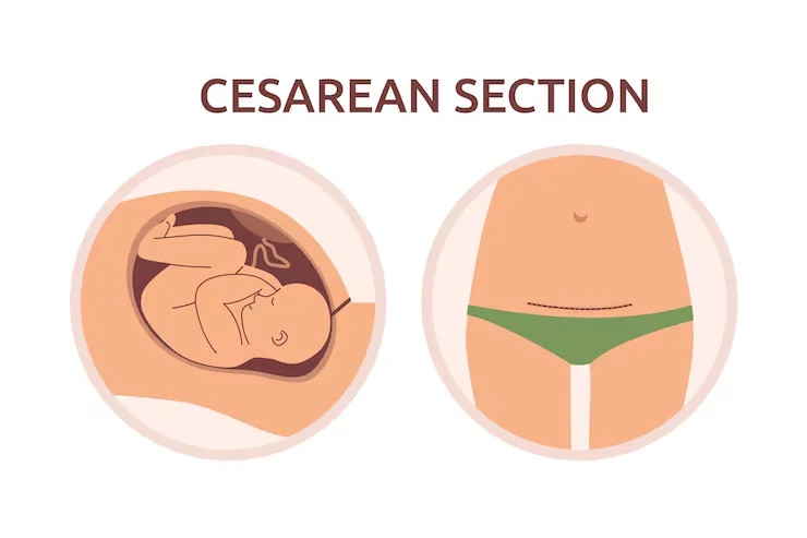 Cesarean.